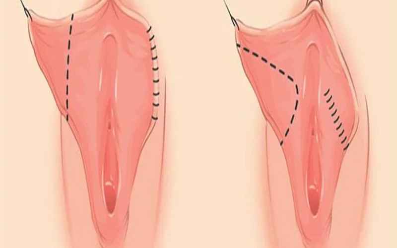 جراحی لابیاپلاستی